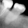 Leczenie kanałowe - Ząb trzonowy dolny wymagający leczenia kanałowego.